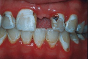 decalcification