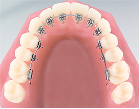 Lingual braces picture